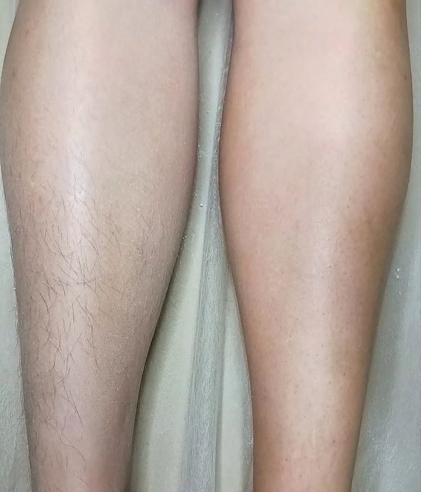 Профессиональная депиляция шугаринг, полимерный воск