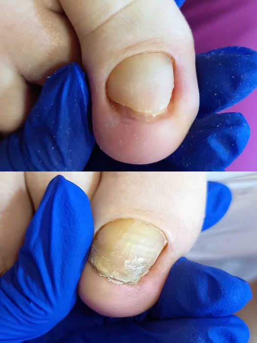 Pedichiură medicală Târgu Mureș