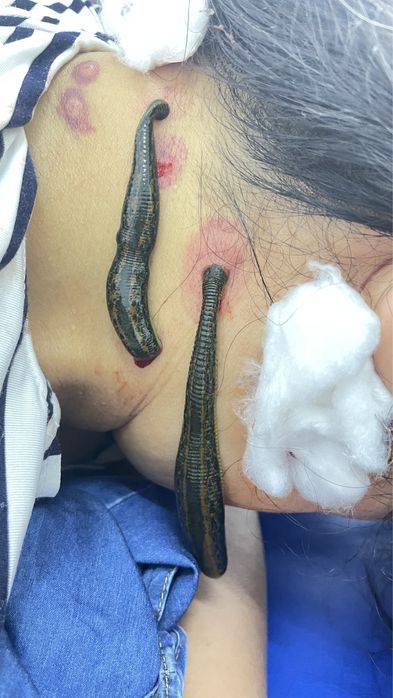 Лечение пиявками, сүлікпен емдеу