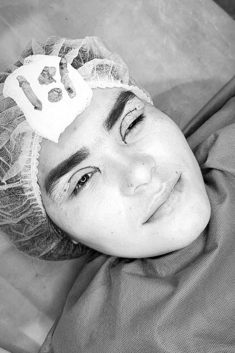 Блефаропластика Броулифтинг