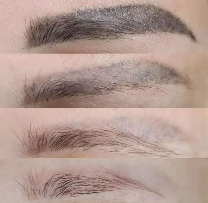 Удаление татуажа 6000тг