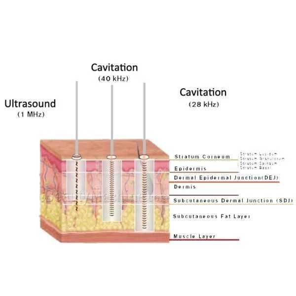 Cavitatie cu ultrasunete 50 lei / 20minute sau 70 de lei 2 sedinte