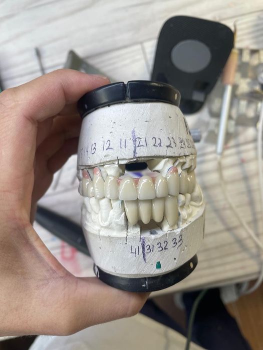 Тіс Протезирование