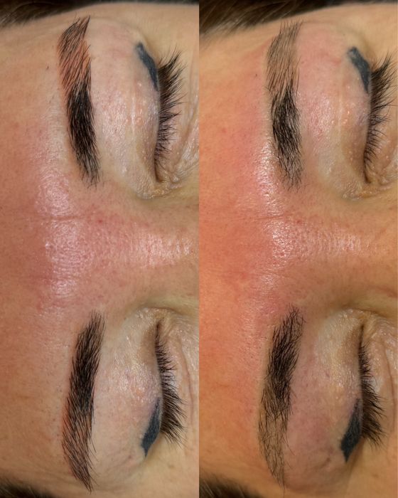 Лазерное удаление татуажа