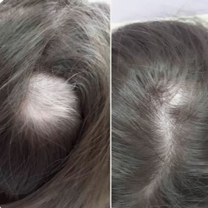 Plazmalifting,yuzga va soch tùkilishiga, Плазмалифтинг