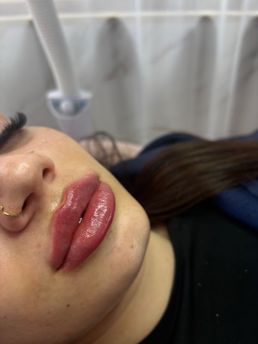 Acid hialuronic in buze