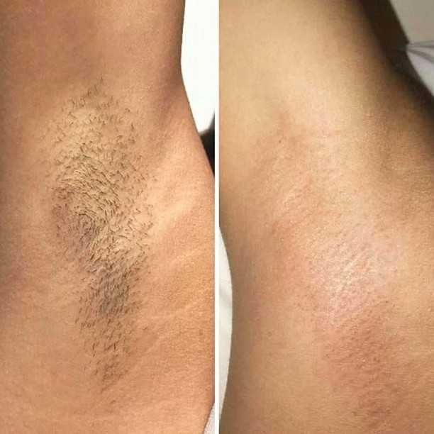 Лазер за епилация под наем