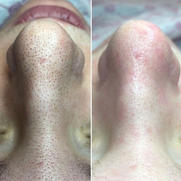 Шугаринг чистка лица мужская