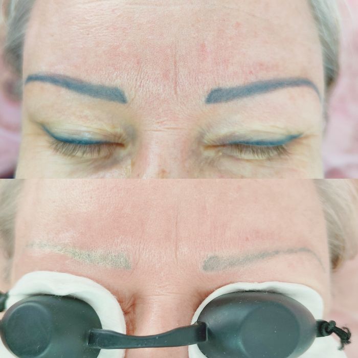 Удаление татуажа, тату