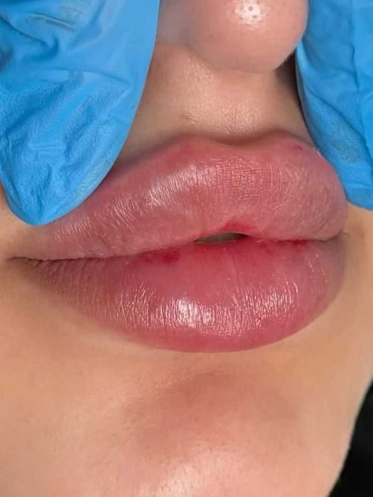 Увеличение Губ наполнение носогубки