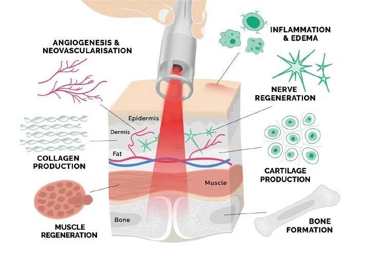 Високоинтензивен лазер AresPro HP Laser