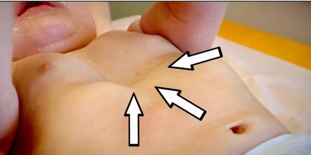 Срочно продам детский вакуум Pectus Excavatum