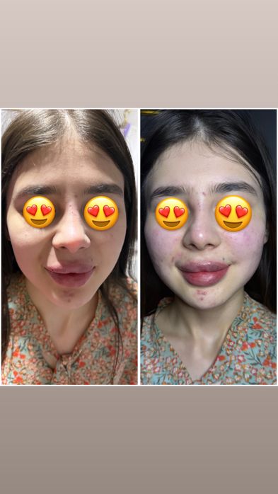 Kosmetologik proceduralafga 50% skidka