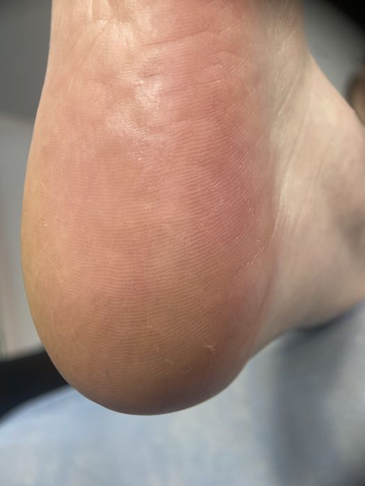 Подолог.Бородавки.Вросший ноготь