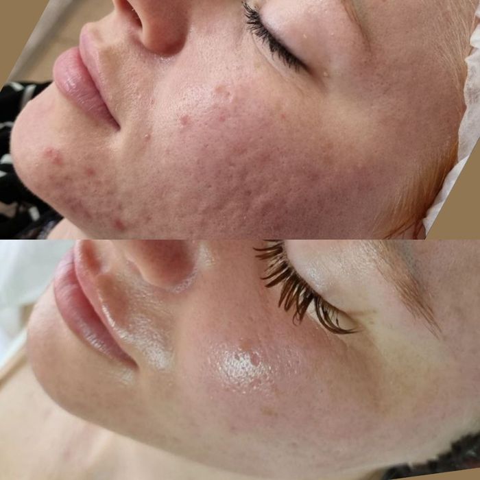 Косметолог блефаропластика,Броулифтинг.Лабиопластика.