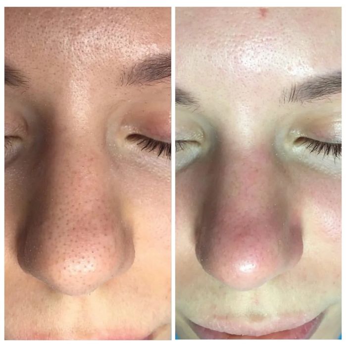 Акция по 250 тысяч Чистка лица ПилингКарбокситерапия механическая чист