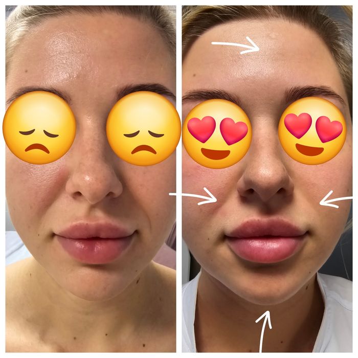 Чистка лица АКЦИЯ