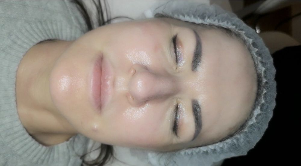 HydraFacial profesional – curățare profundă și hidratare intensă