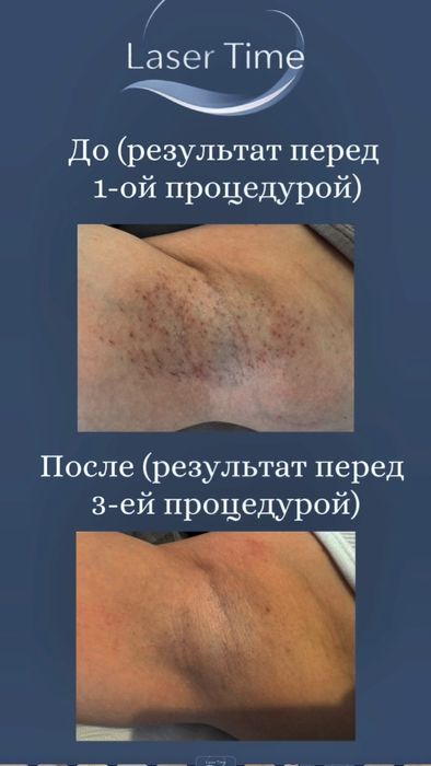 Лазерная эпиляция