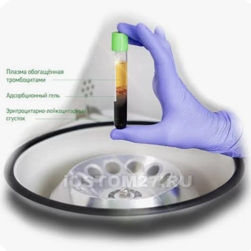 Plazmalifting,yuzga va soch tùkilishiga, Плазмалифтинг