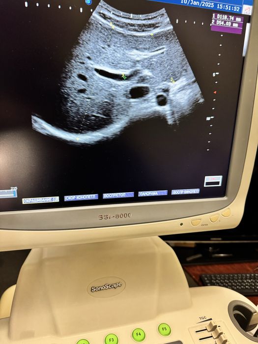 Узи аппарат SonoScape SSI 8000