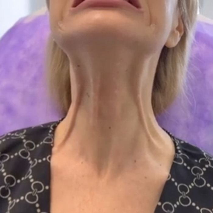 Botoks. Yuzdagi ajinlarni yuqotish ,