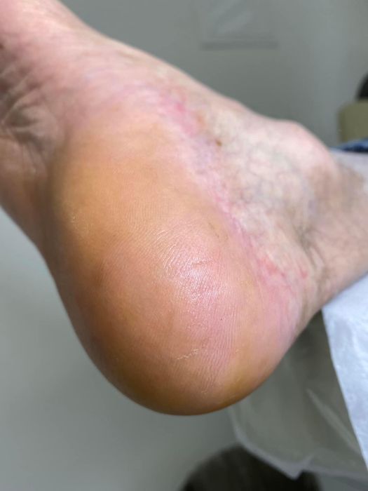 Pedichiură Medicală