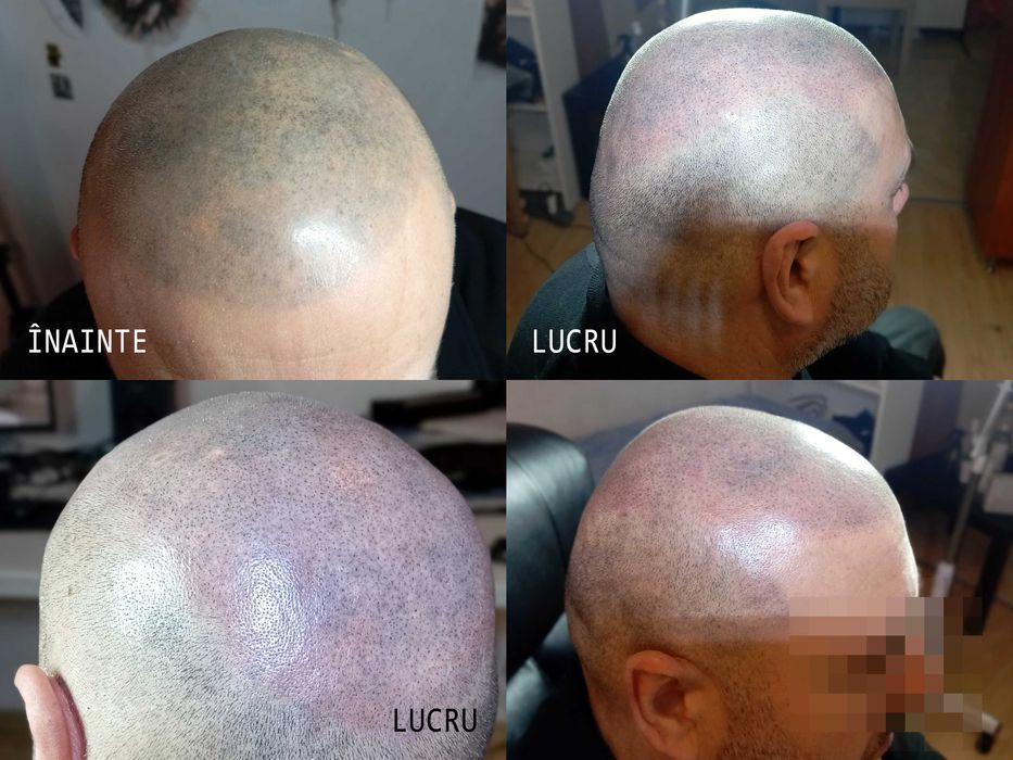 Caut modele pt. micropigmentare scalp chelie / păr rar -  tarif ofertă