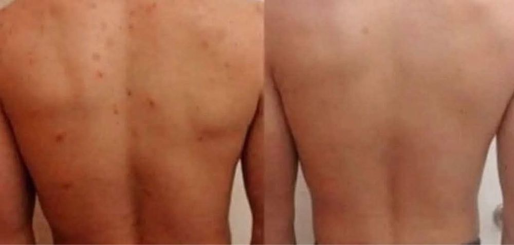 Tratament cosuri  nu skin