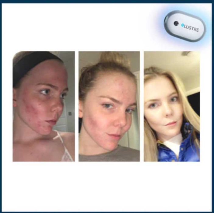 Сбогом АКНЕ! Уред срещу акне LUSTER Pure Light Pro