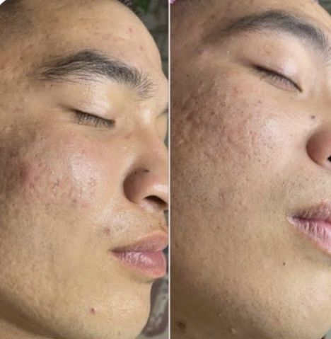 Yuzni chishtka qilish. Глубокая чистка лица