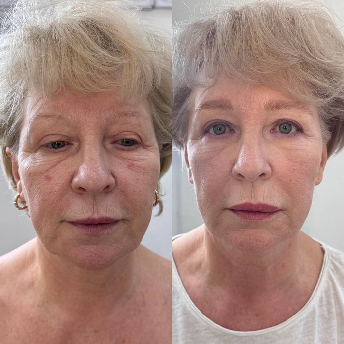 Скидки на ботокс! Диспорт (DYSPORT)