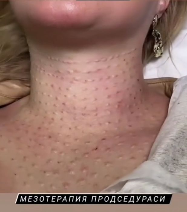 Yuzga meza terapiya,  Косметолог,  меза терапия лица и шеи 1+1