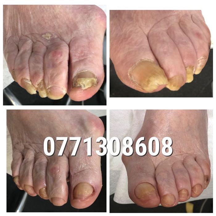 Pedichiura medicala.Instrumentar sterilizat in autoclav.Liftup gel