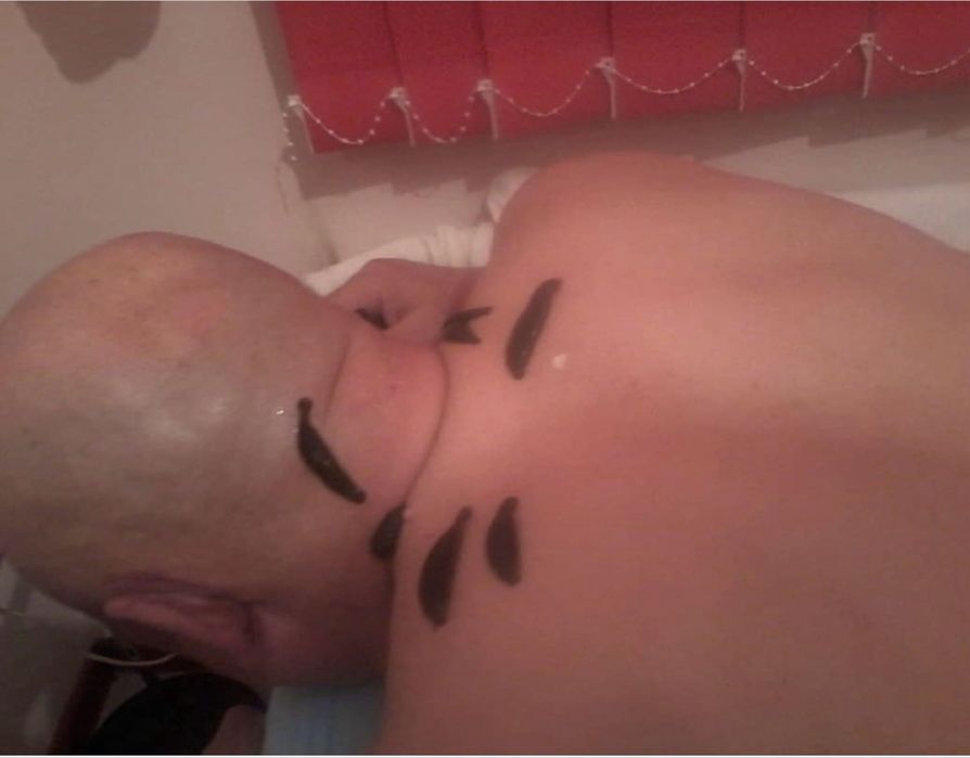 Хиджама, Гирудотерапия (сүлік салу емі)