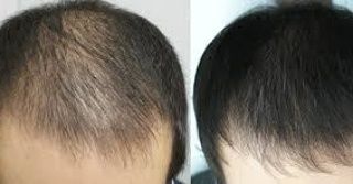 Чистка лица для мужчин