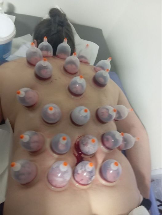 Hijoma zuluk med pratsedura