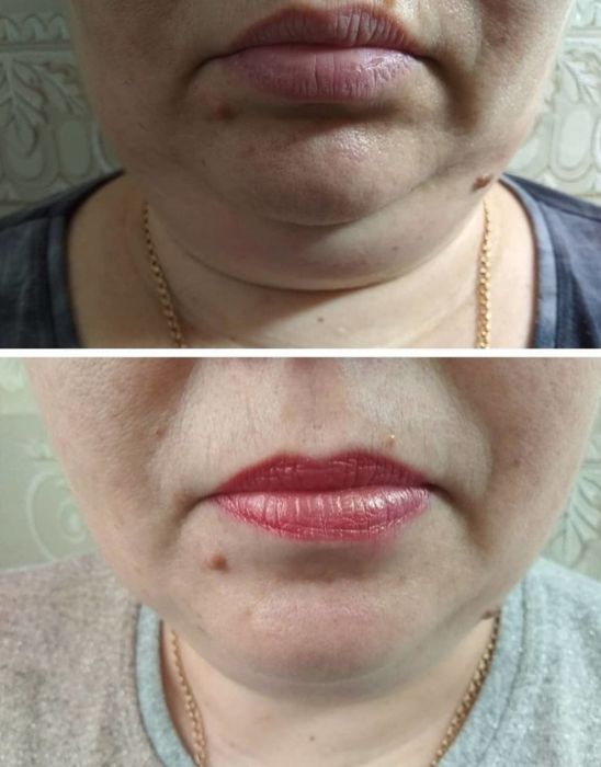 Липолитики. Живот, бедра, лицо, второй подбородок.