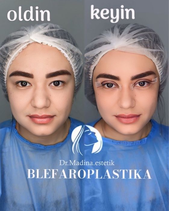 -50% CHEGIRMADA Blefaroplastika