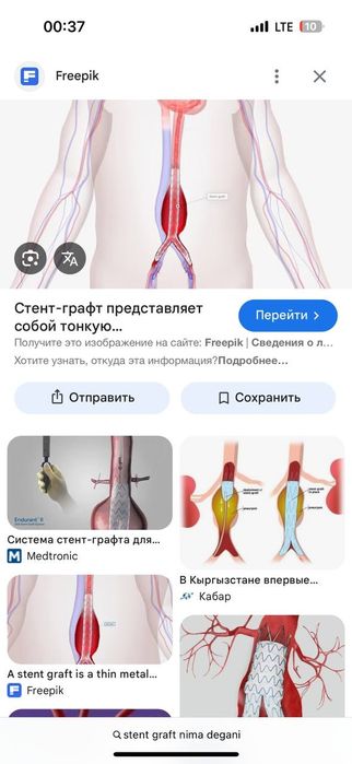 Srochna STENT-GRAFT 0.035  aorta tomirlariga yangi ochilmagan