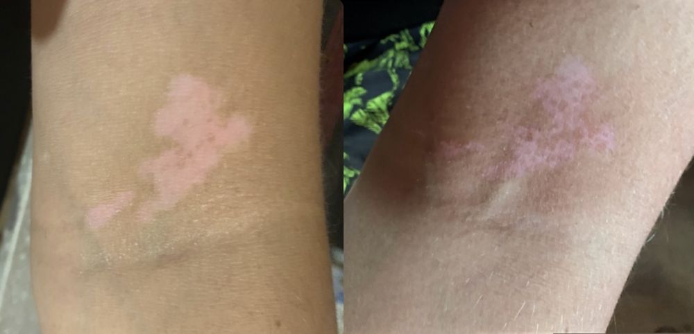 311 нм лампа  (UVB- Philips) витилиго, псориаз даволовчи лампа