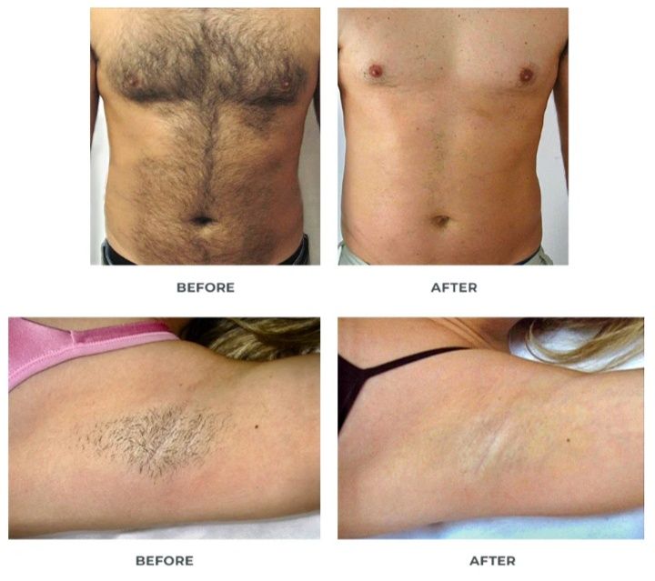 Эпиляция мужчины и женщины все зона депиляция тоже есть Доп услуги ест