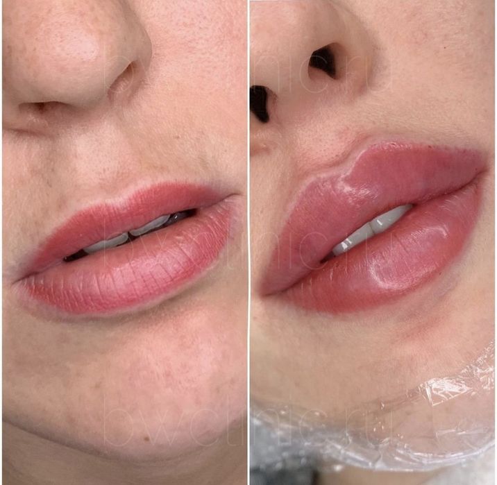 Акция Увелечение губ