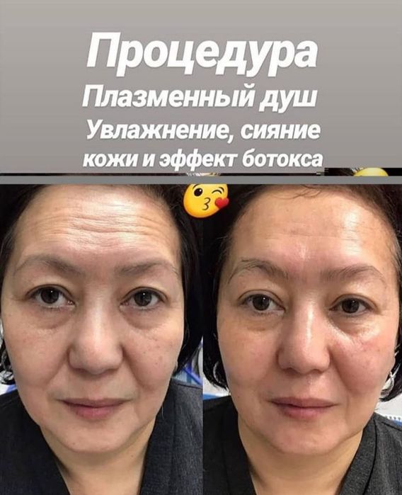 Продам аппарат холодной плазмы.