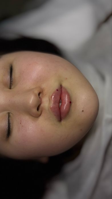 Акция губы, ботокс, чистка, плазма