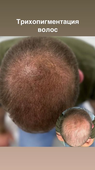 Трихопедментация головы