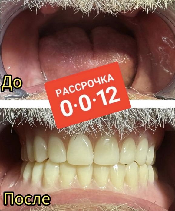 Сьемные зубные протезы на выезд , на дому , вакумная фиксация