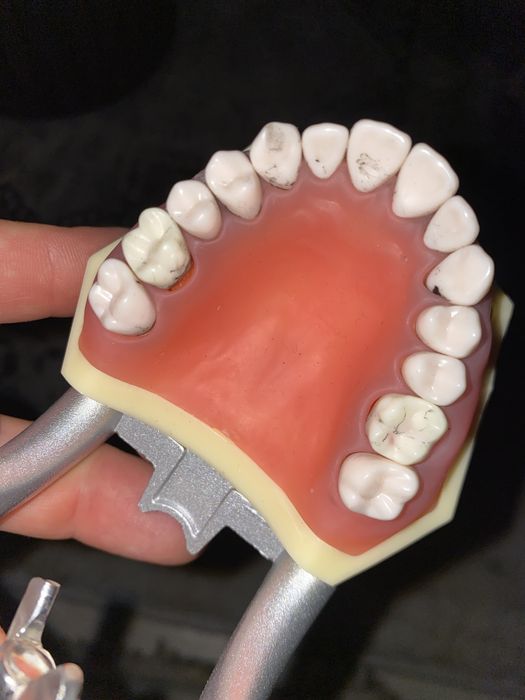 Arcadă dentară cu boală parodontală și tartru