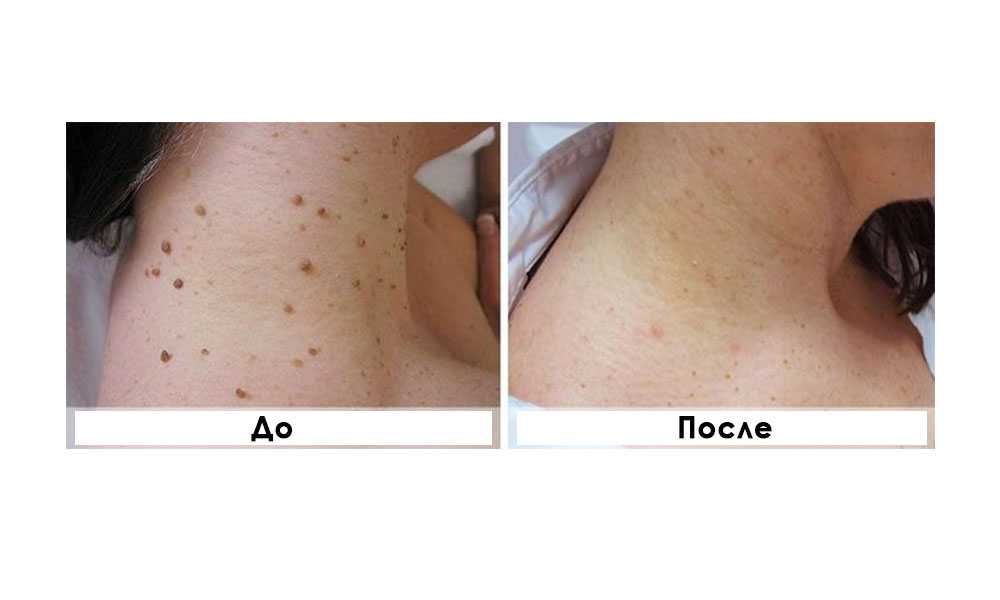 Удаление папиллом, электрокоагуляция и лазер. Papilloma yo'qotish.