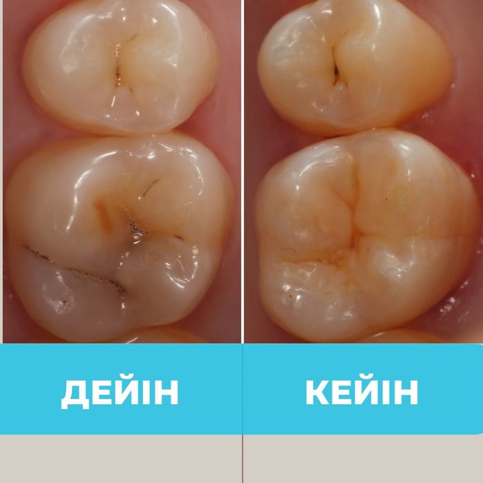 Алматы тіс емдеу , стоматолог